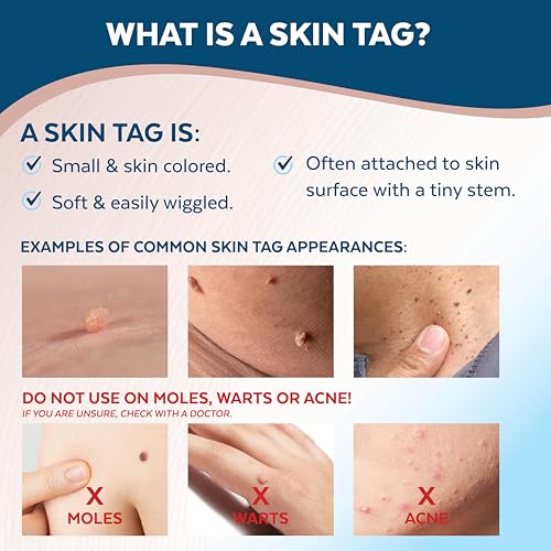 Advanced Skin Tag Remover - FDA-Cleared Device - Only for Skin Tag Removal - Works in 7-14 Days - Up to 10 Treatment Cycles - Cryogenic Freeze-Off Kit