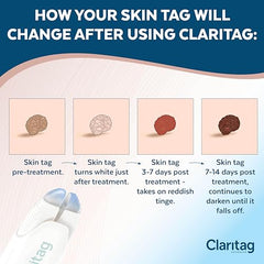 Advanced Skin Tag Remover - FDA-Cleared Device - Only for Skin Tag Removal - Works in 7-14 Days - Up to 10 Treatment Cycles - Cryogenic Freeze-Off Kit