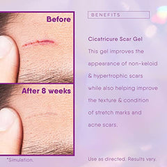 Cicatricure Face & Body Scar Gel, Scar Treatment for Old & New Scars, Stretch Marks, Surgery, Injuries, Burns and Acne Scar Treatment, 1 Ounce